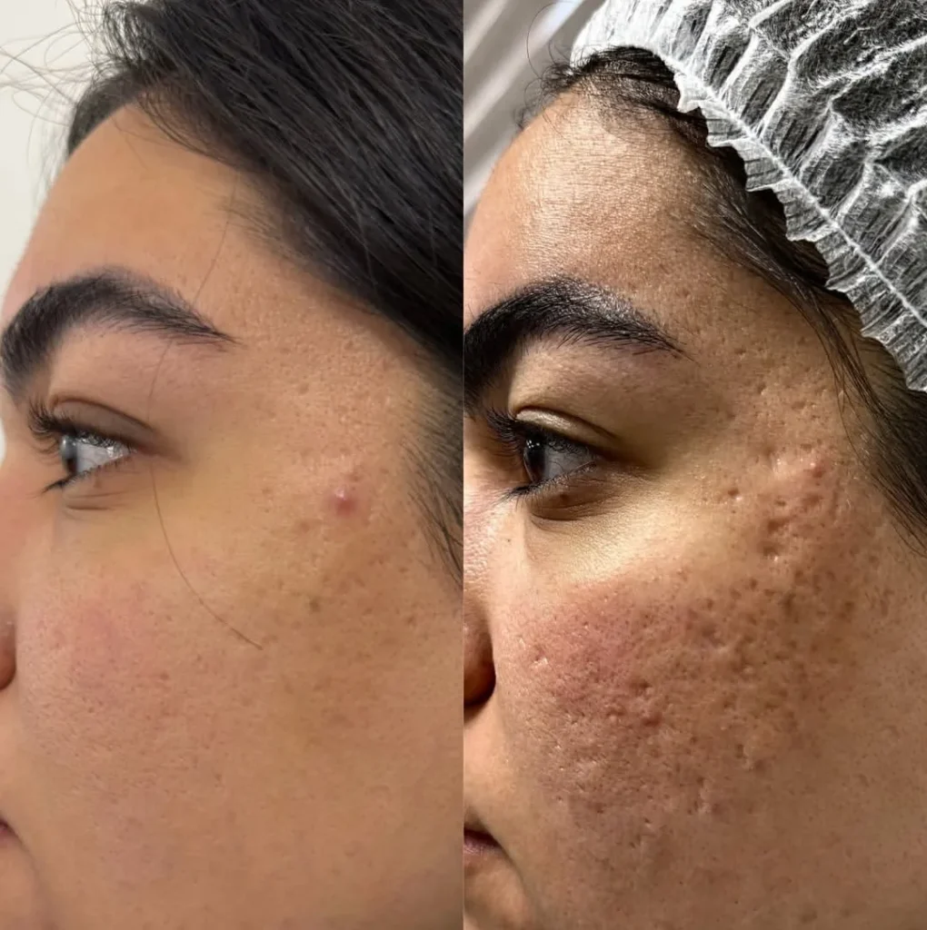 Acne Scar Treatment Before and After Results