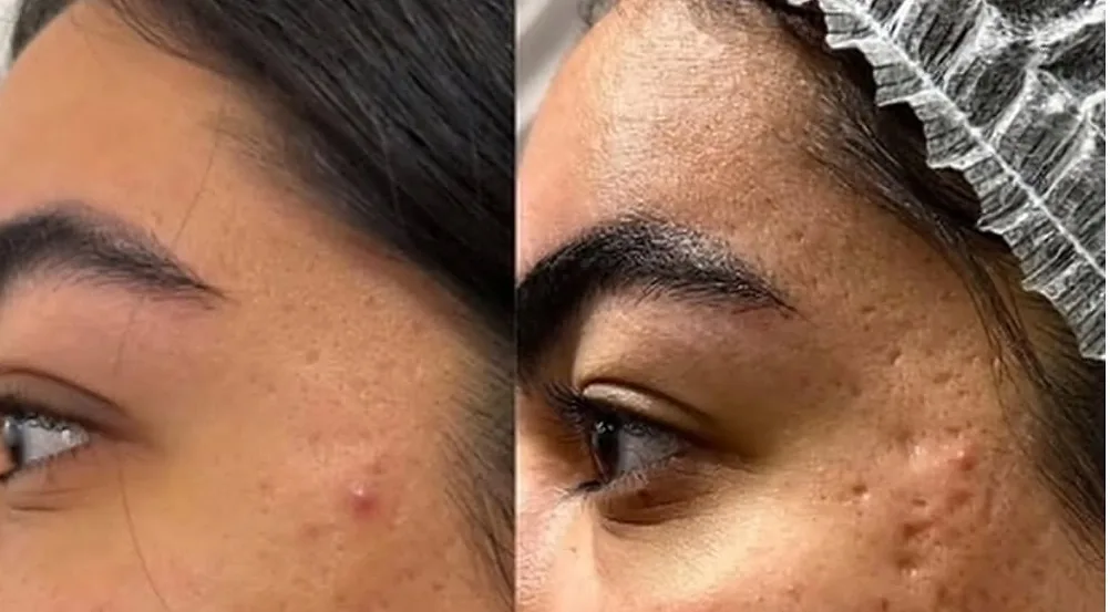 Acne Scar Before and After Microneedling Treatment