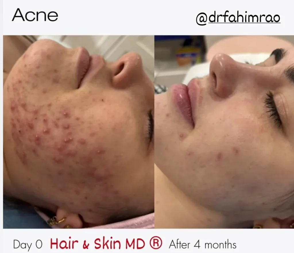 Acne Treatment Before and After Skin Improvement