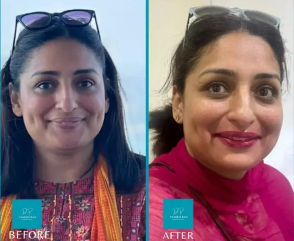 Facial Contouring Before and After Dermal Filler Treatment