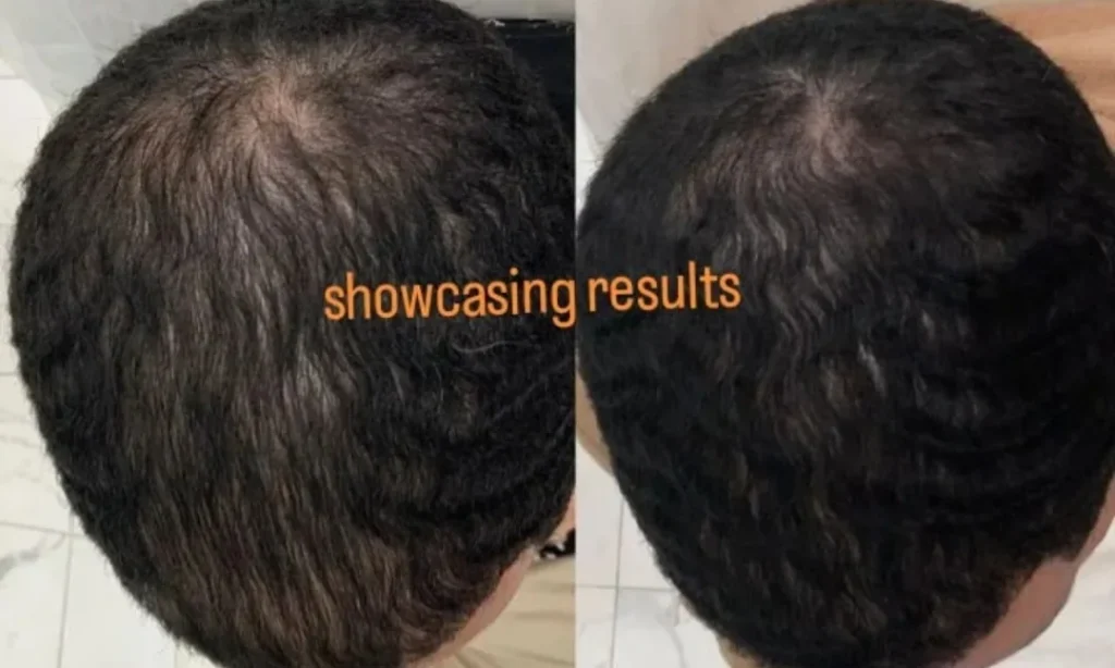 Hair Density Before and After PRP Hair Restoration
