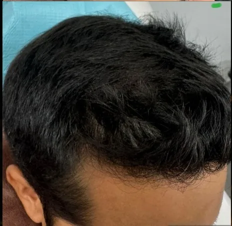 Hair Regrowth Before and After PRP Hair Therapy
