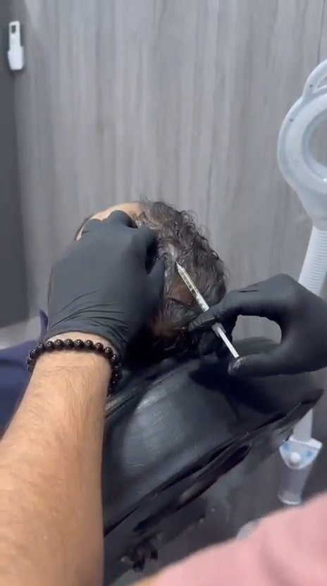 Hair Restoration Procedure Video Thumbnail