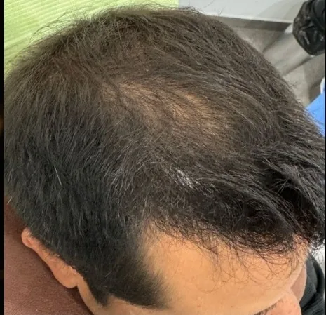 Hair Thinning Before and After PRP Treatment