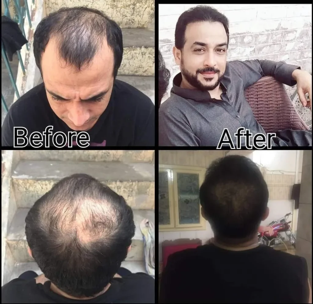Hair Transplant Before and After Results