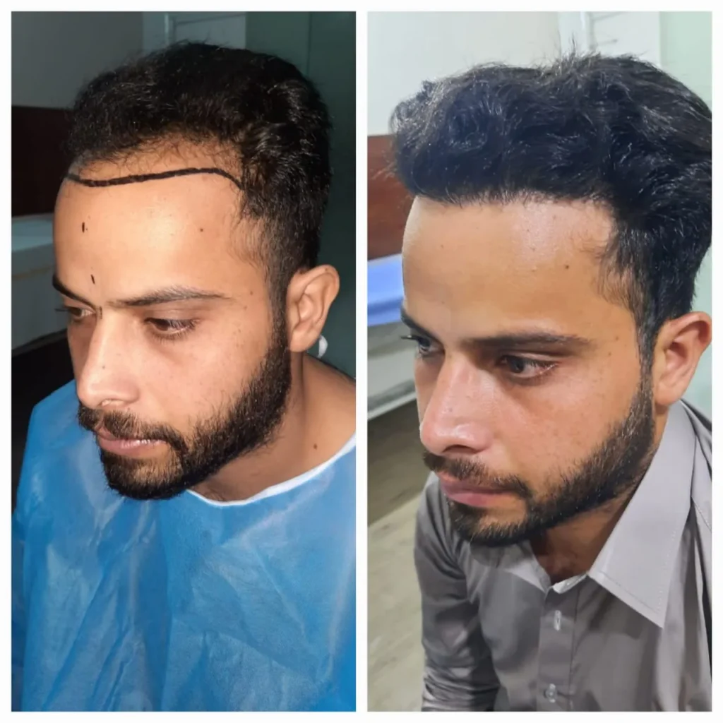 Hair Transplant Before and After Hair Growth Results