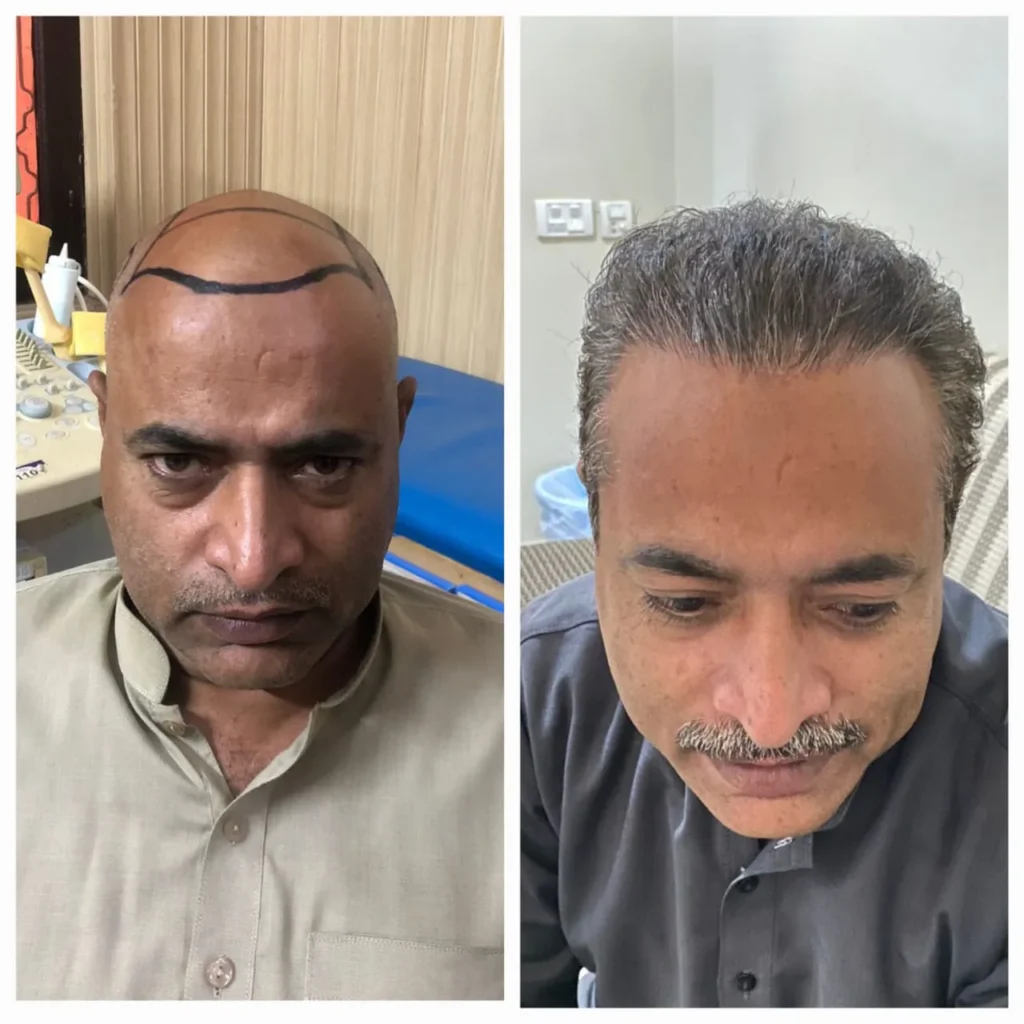 Natural Hairline Hair Transplant Before and After