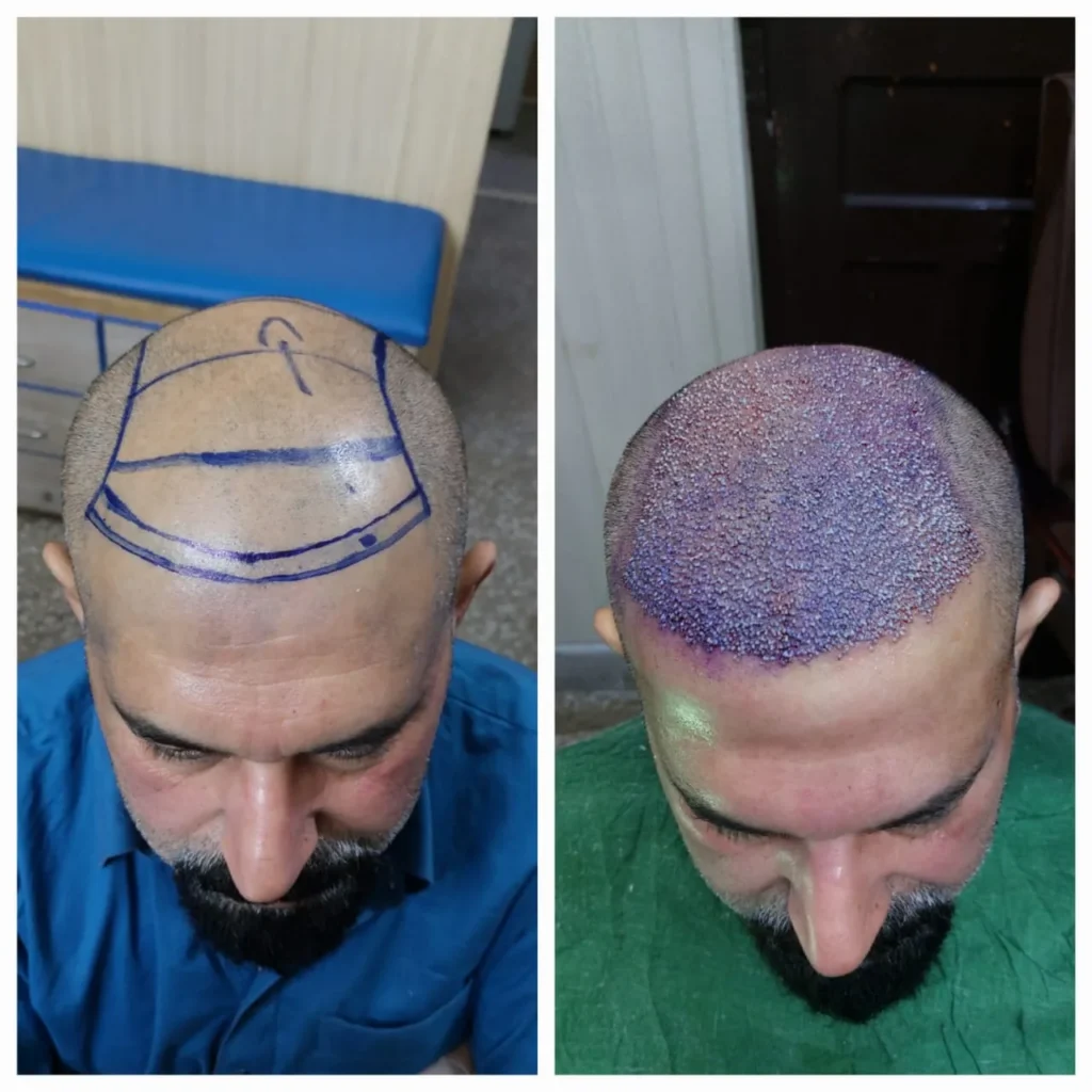 Hair Transplant Hairline Planning and Graft Placement