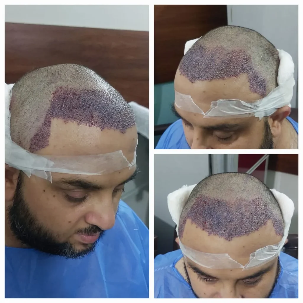 Hair Transplant Procedure with Graft Placement