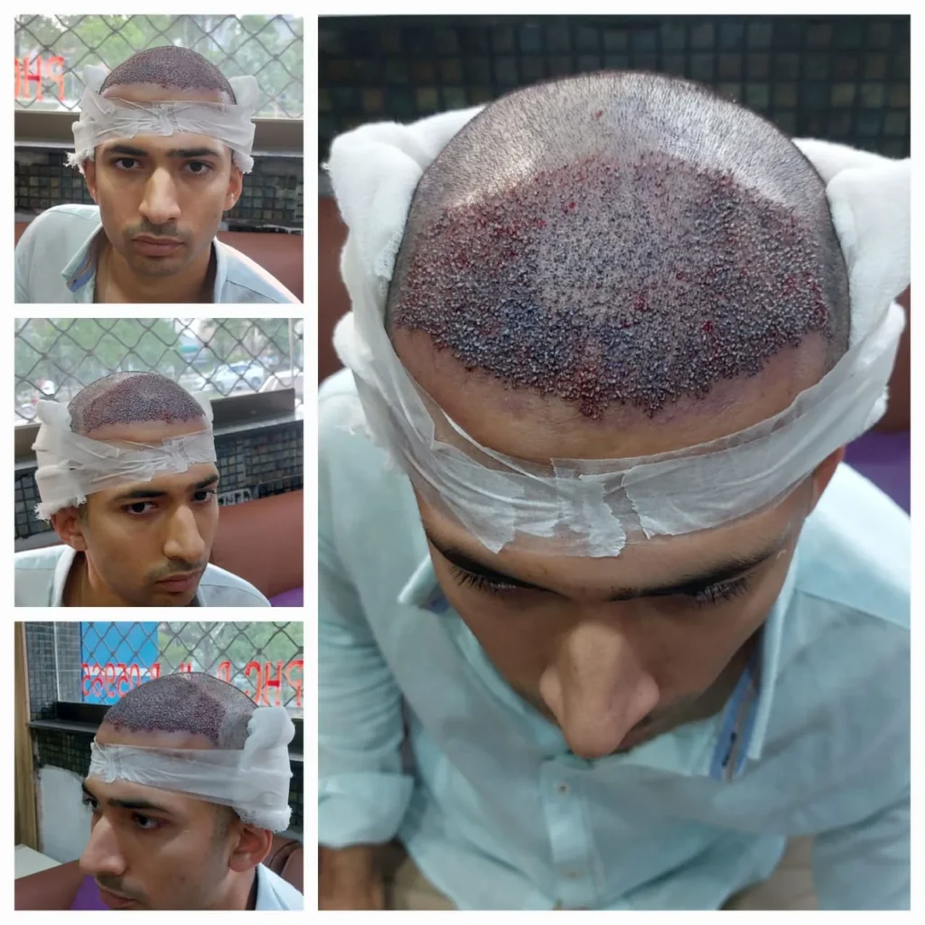 Hair Graft Implantation During Hair Transplant Procedure