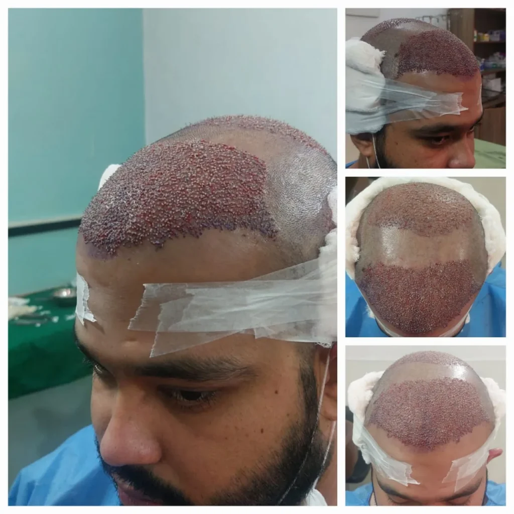 Advanced Hair Transplant Procedure for Hair Restoration