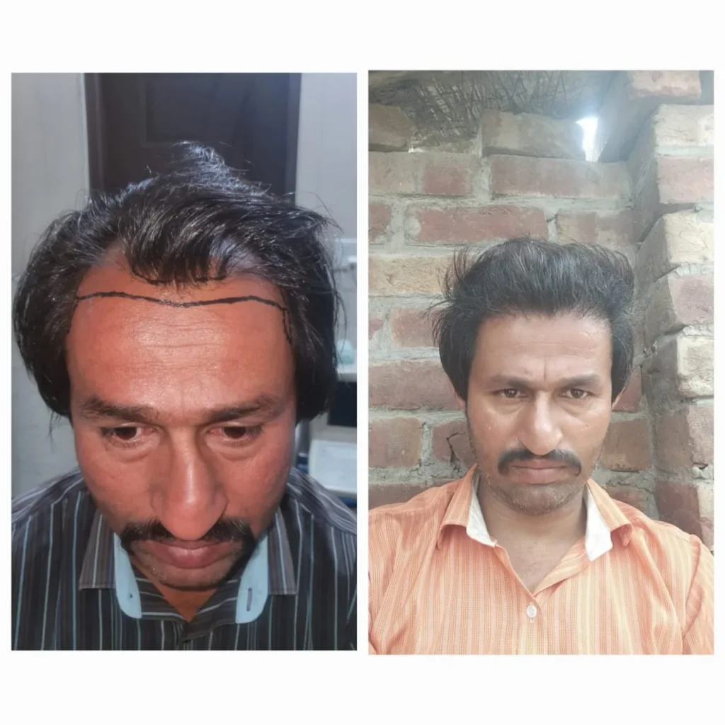 Hairline Restoration Before and After Hair Transplant