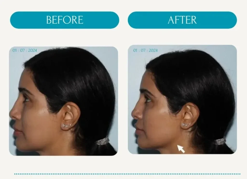 Facial Contouring Before and After Dermal Filler Treatment