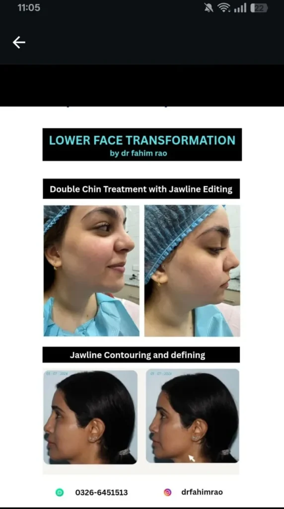 Lower Face Jawline Before and After Dermal Filler Treatment