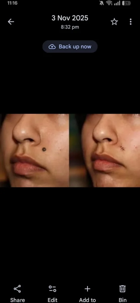 Mole Removal Before and After Treatment Results