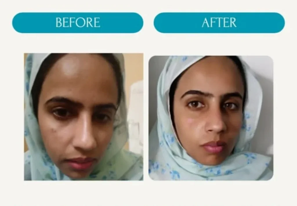 Nose Contouring Before and After Dermal Filler Treatment