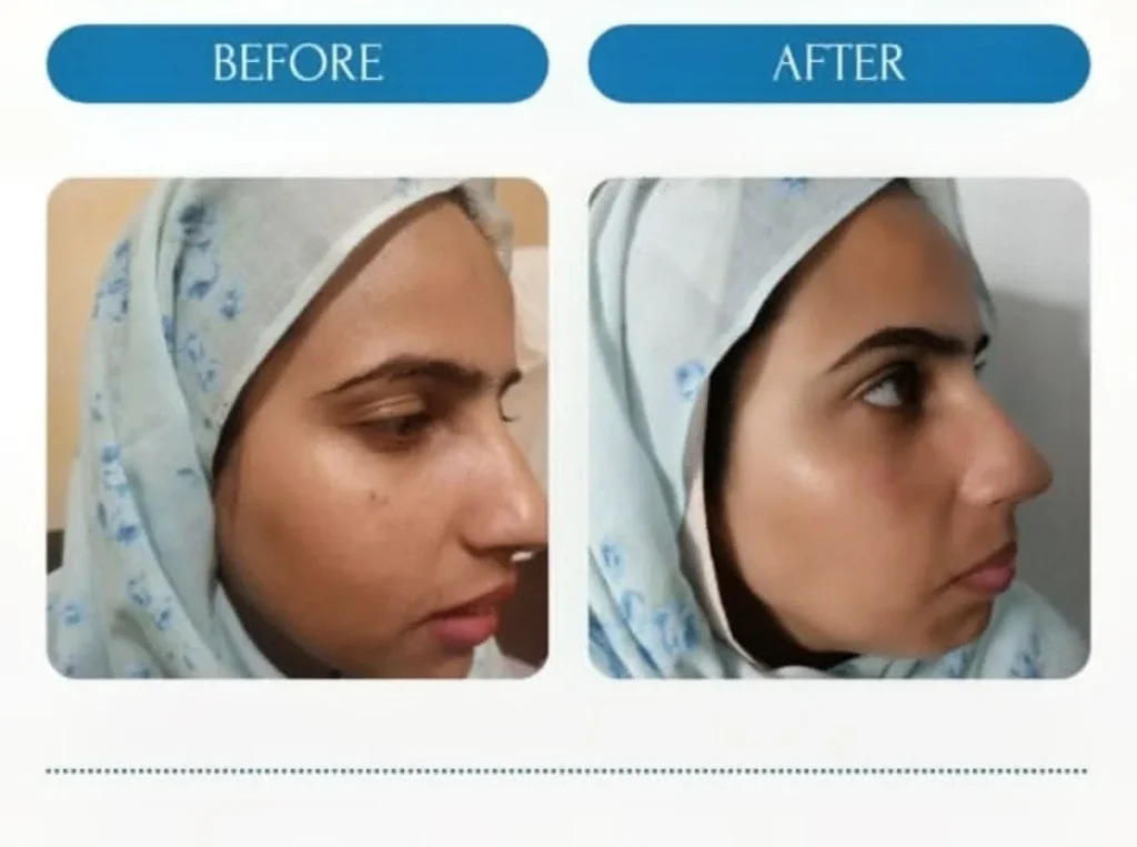 Non-Surgical Nose Contouring Before and After Results