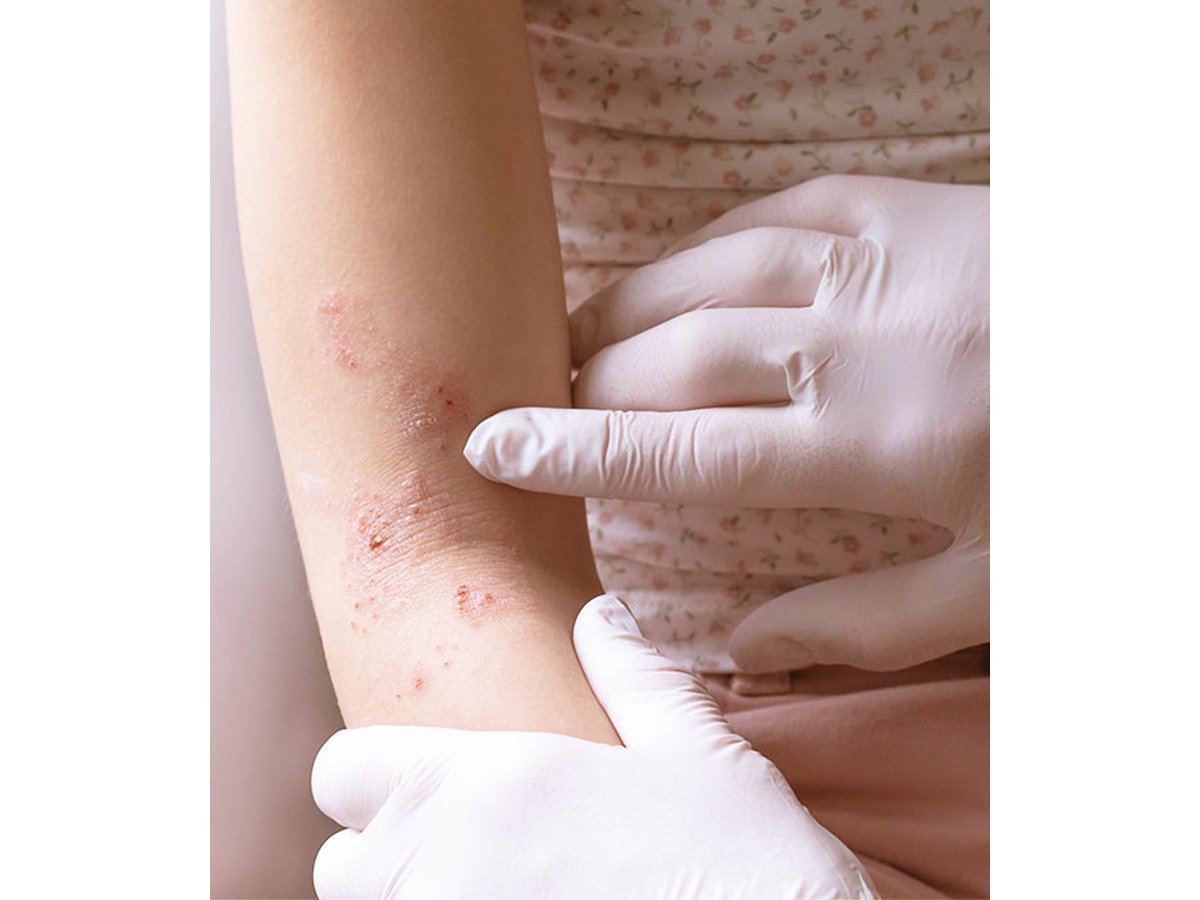 Eczema treatment in Wah Cantt: arm skin assessment by a dermatologist