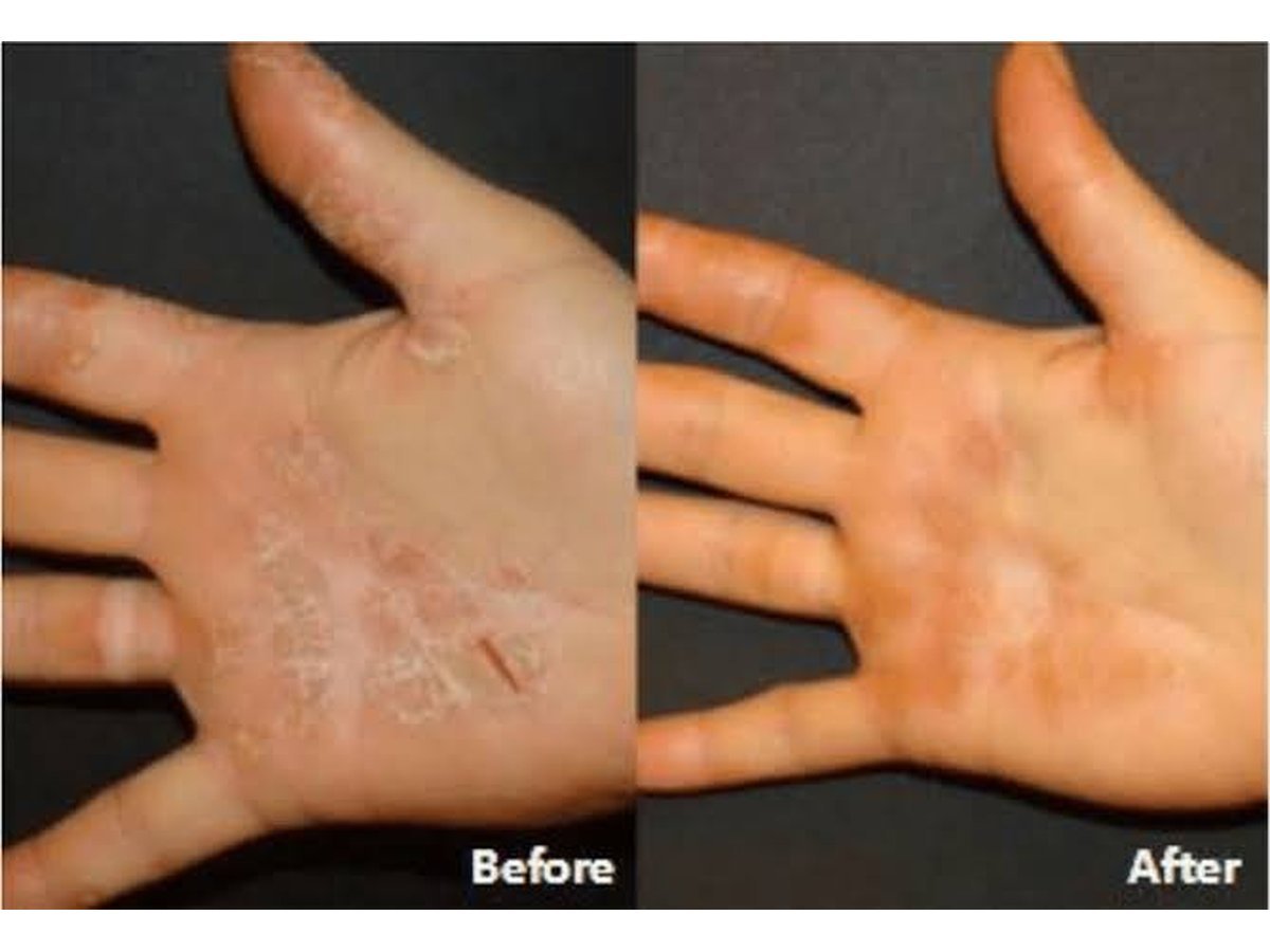 Hand eczema skin concern for discussion during a dermatology consultation